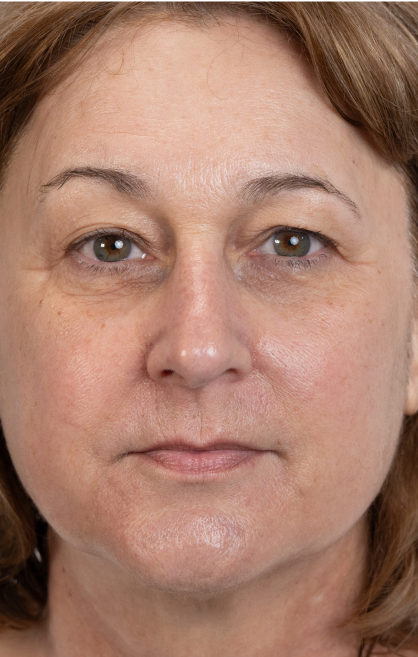 Image d’avant/après